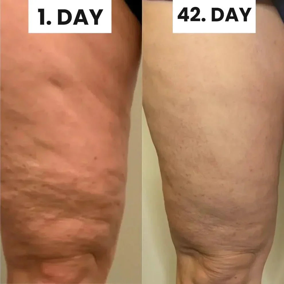 مجموعة Wellness™ لتخفيف السيلوليت